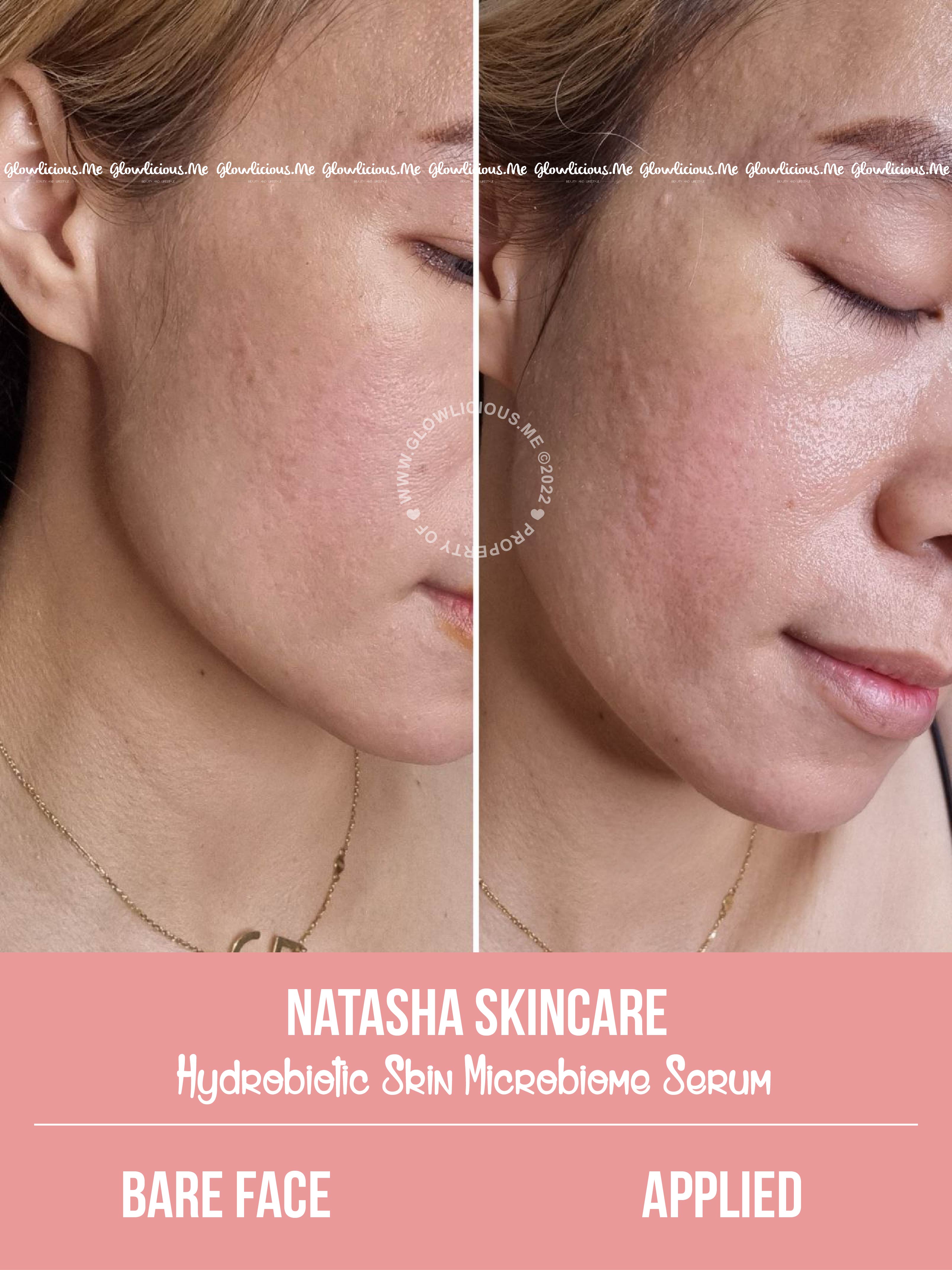 Hasil Pemakaian Before After Natasha Skincare Hydrobiotic Skin Microbiome Serum Di Kulit Kering