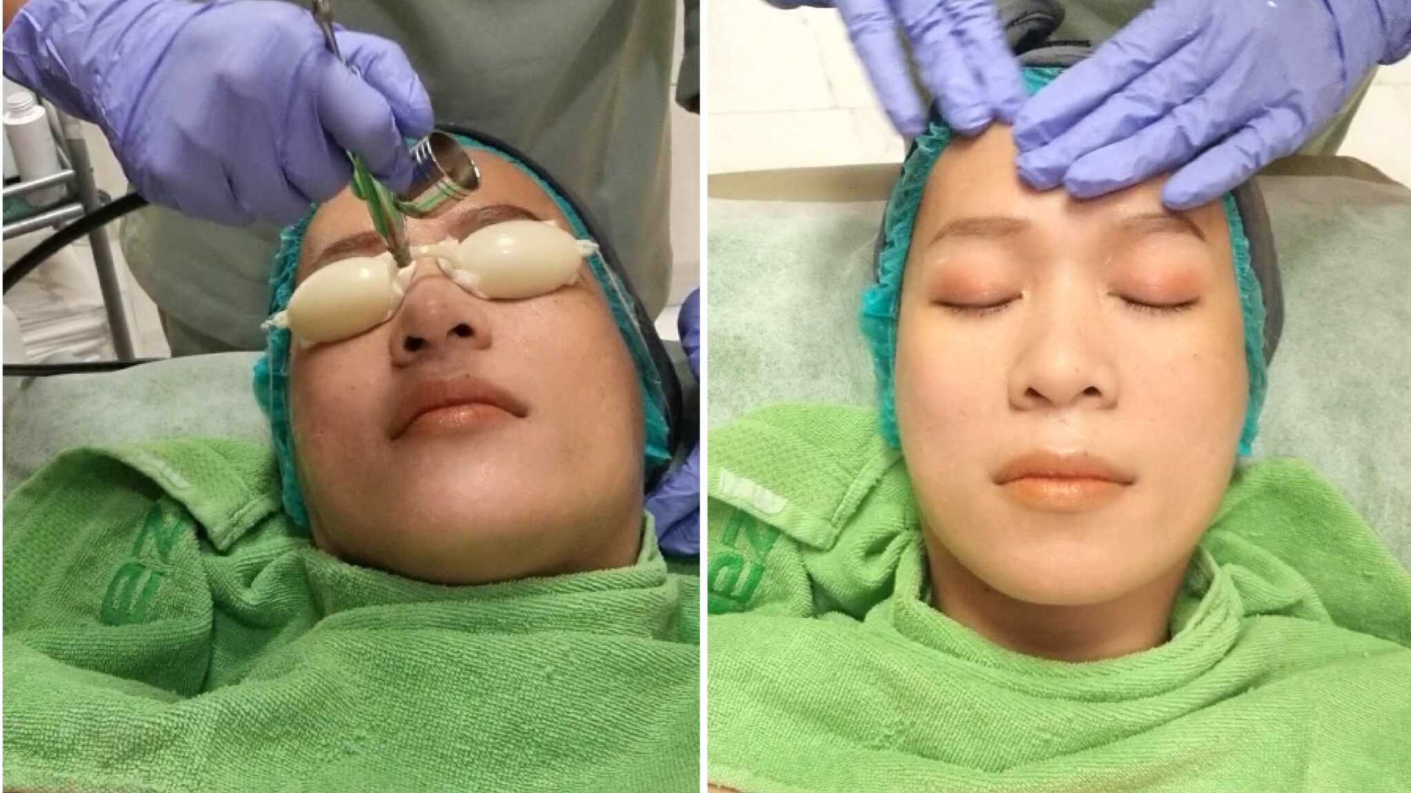 ZAP Treatment Underarm Hair Removal dan Oxy Infusion di ZAP Grand